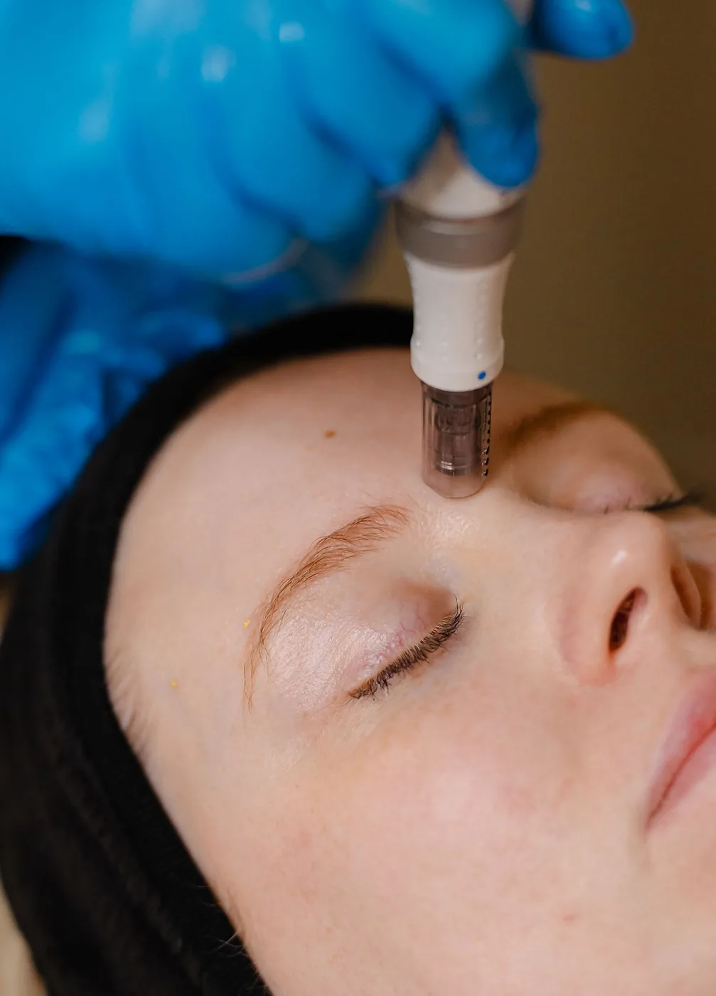 Microneedling Bristol
